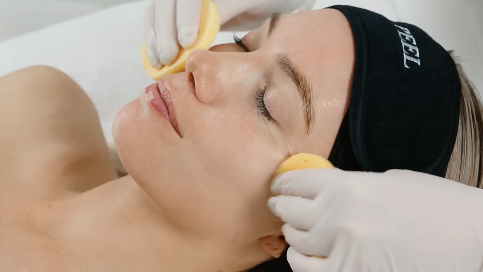 VI Peel treatment at Skin Laser & MedSpa in Streeterville, Chicago