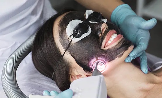 Carbon laser peel Hollywood facial treatment