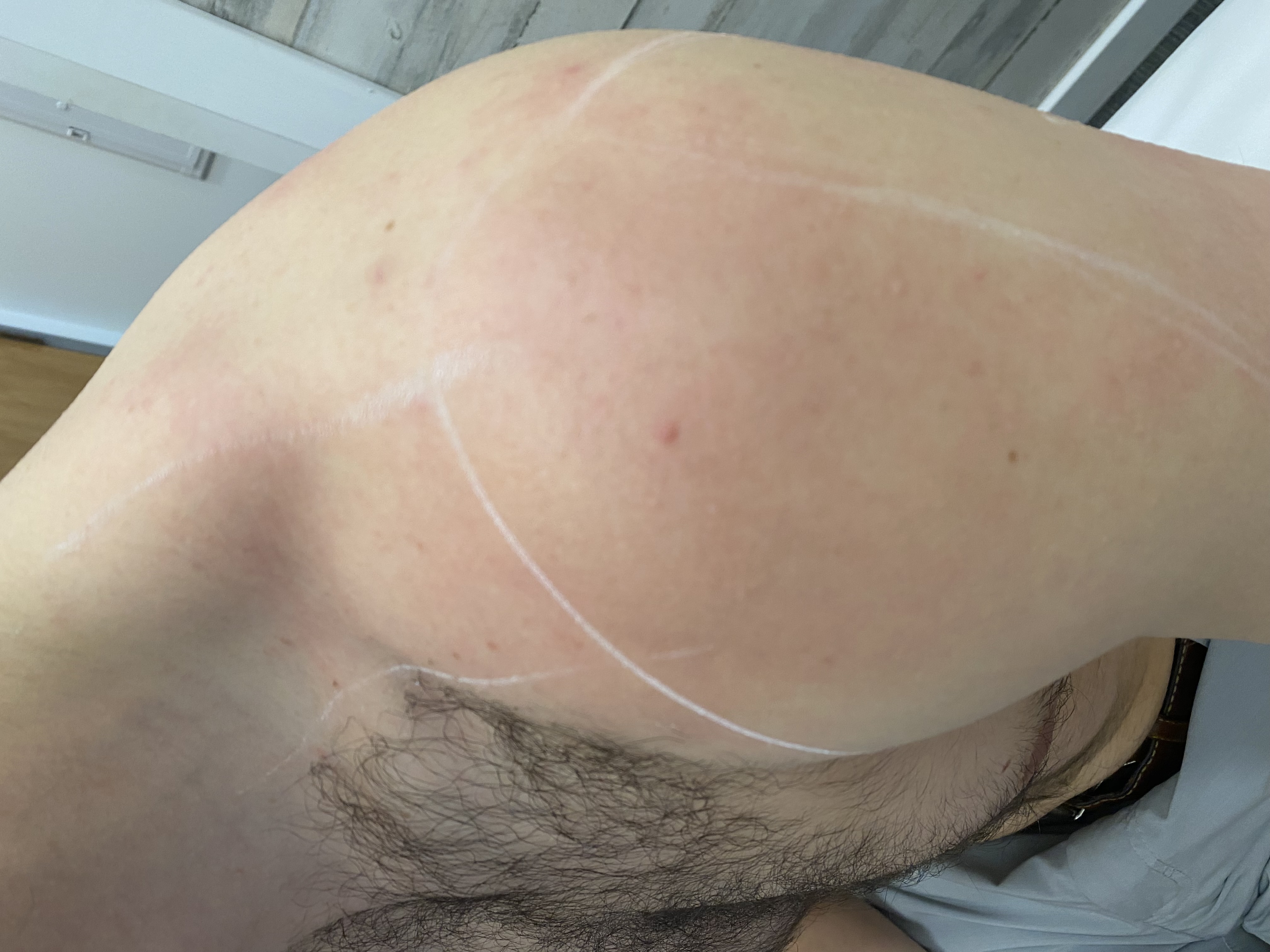 Excess hair before laser hair removal