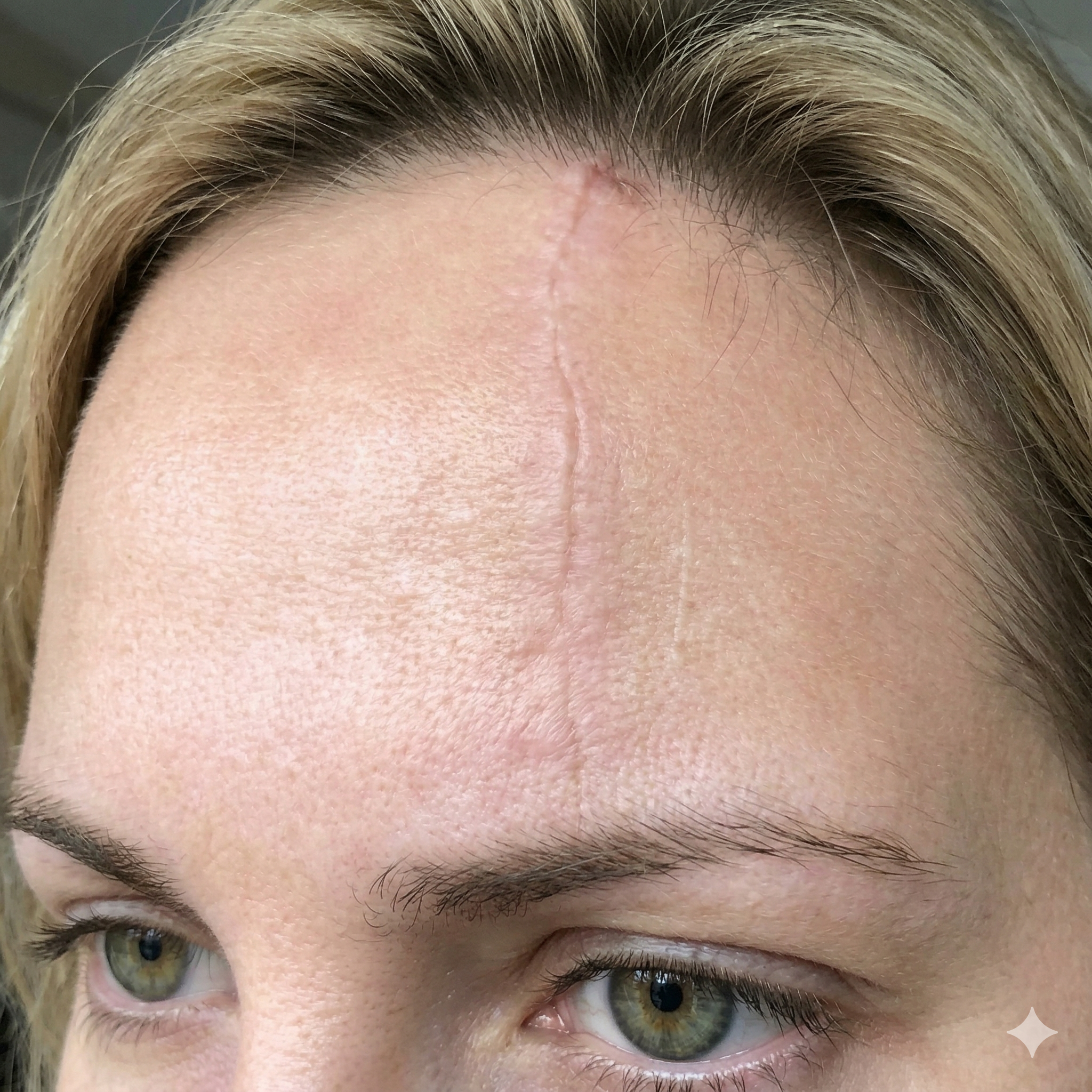 Facial scar on forehead