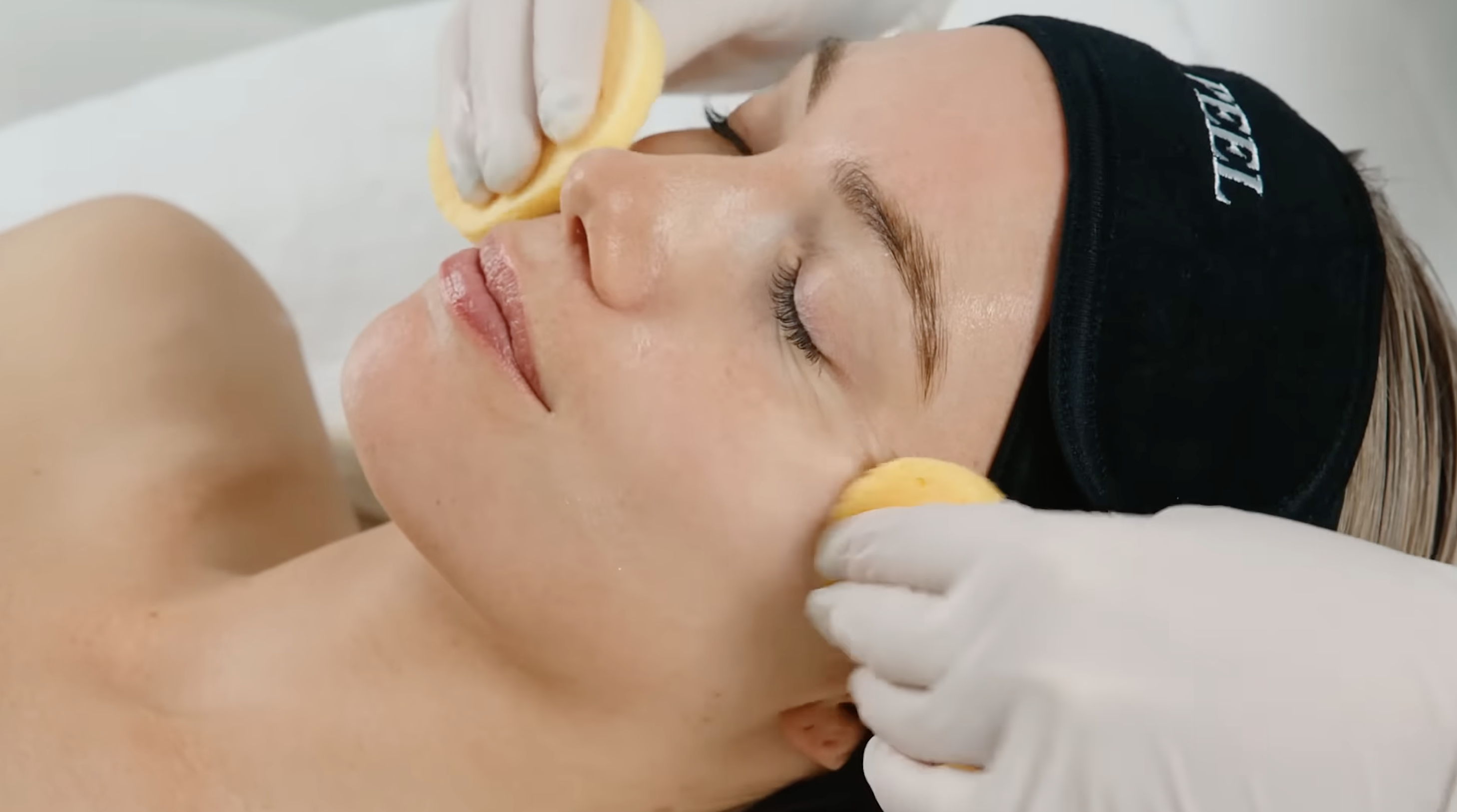 VI Peel treatment